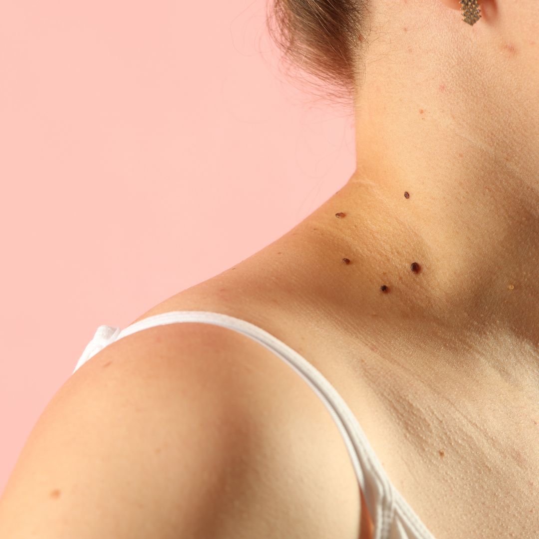 Close-up of neck with visible skin tags before treatment