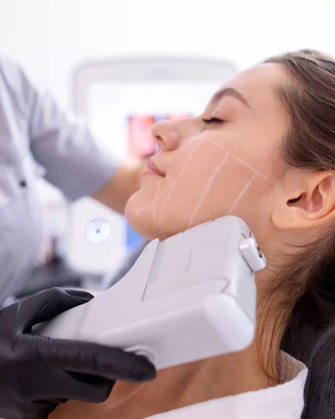 HIFU Treatment Hastings