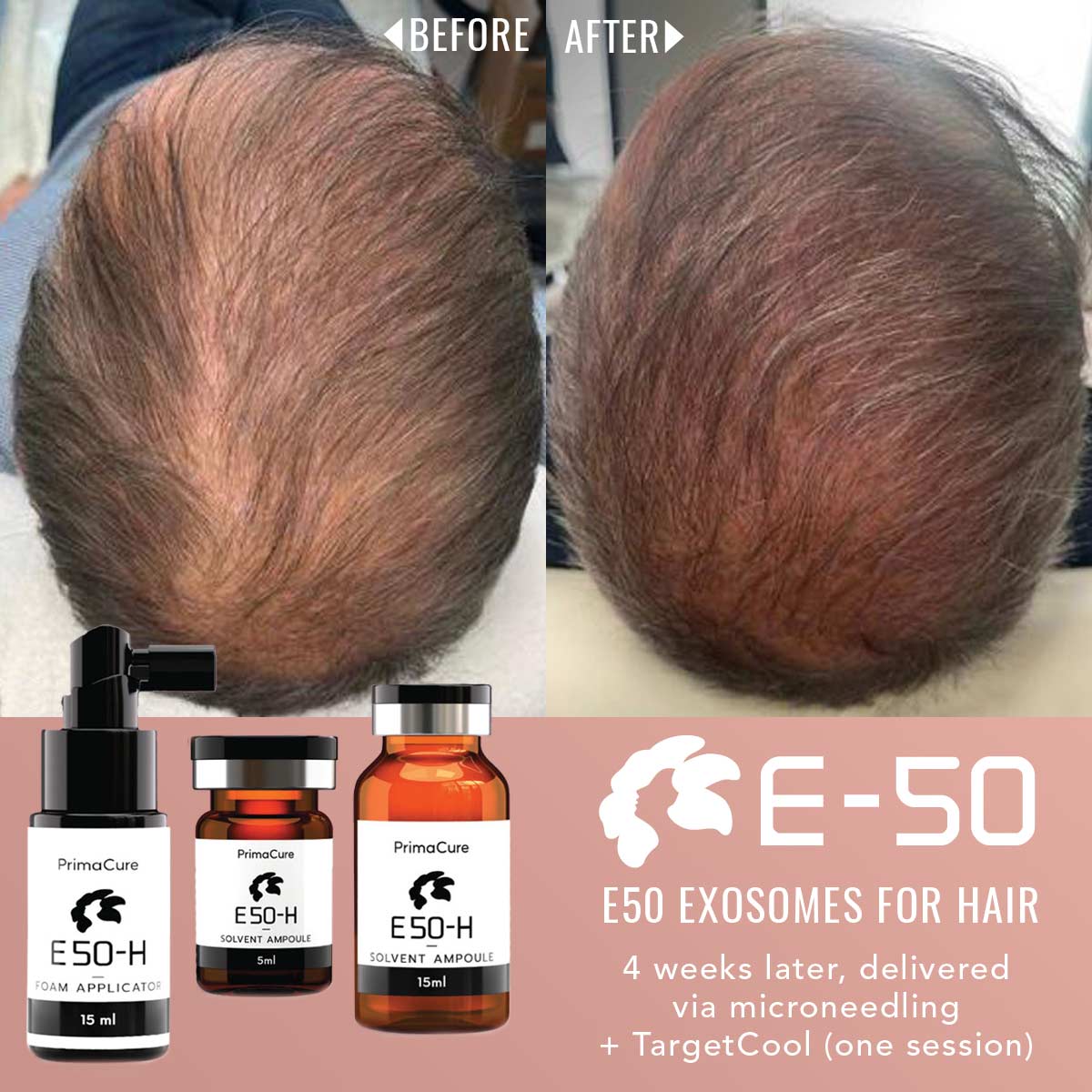 E50-Exosomes for Hair