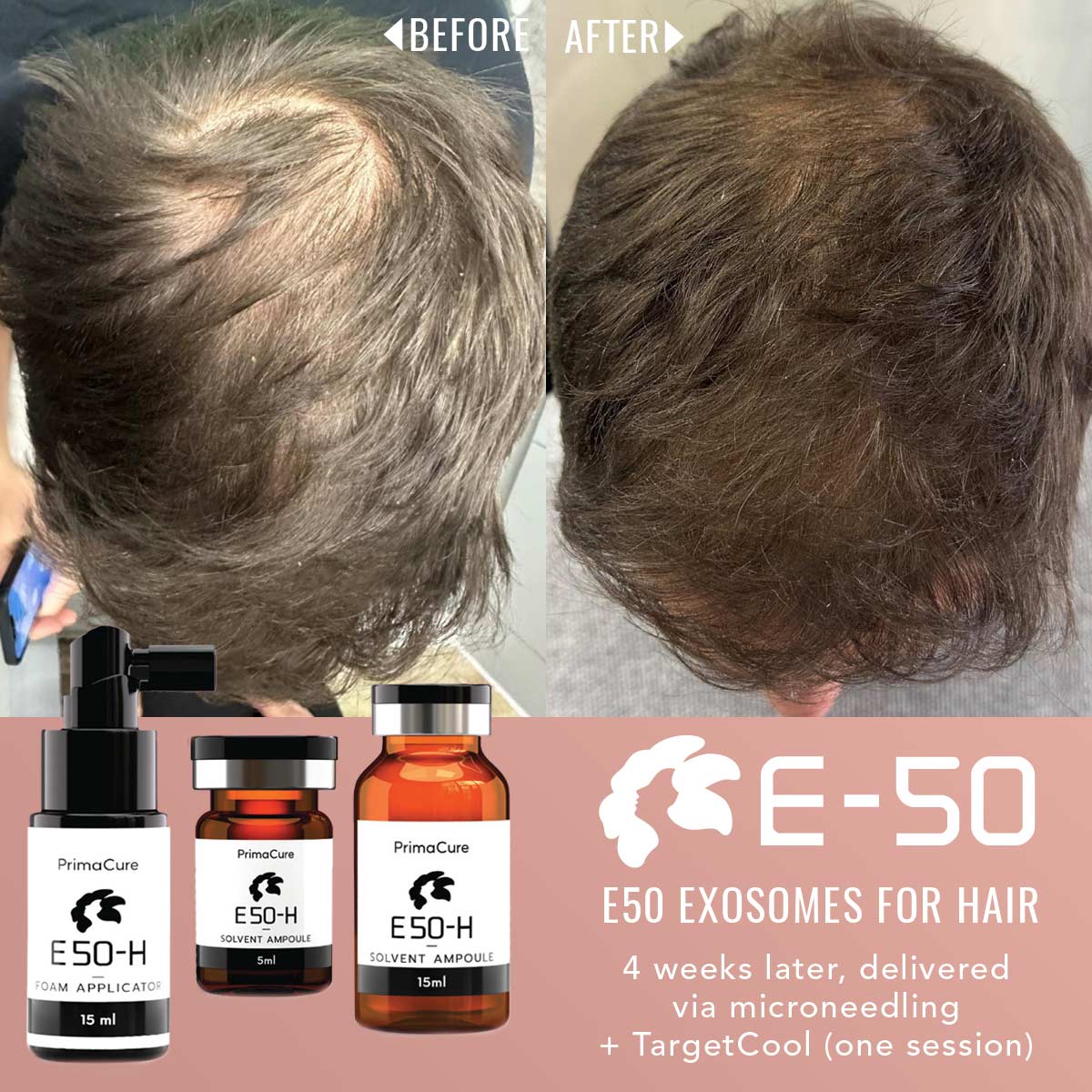 E50-Hair Restoration Exosomes