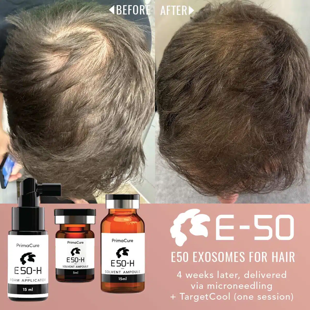 E50-Hair Restoration Exosomes E50-Hair Restoration Exosomes