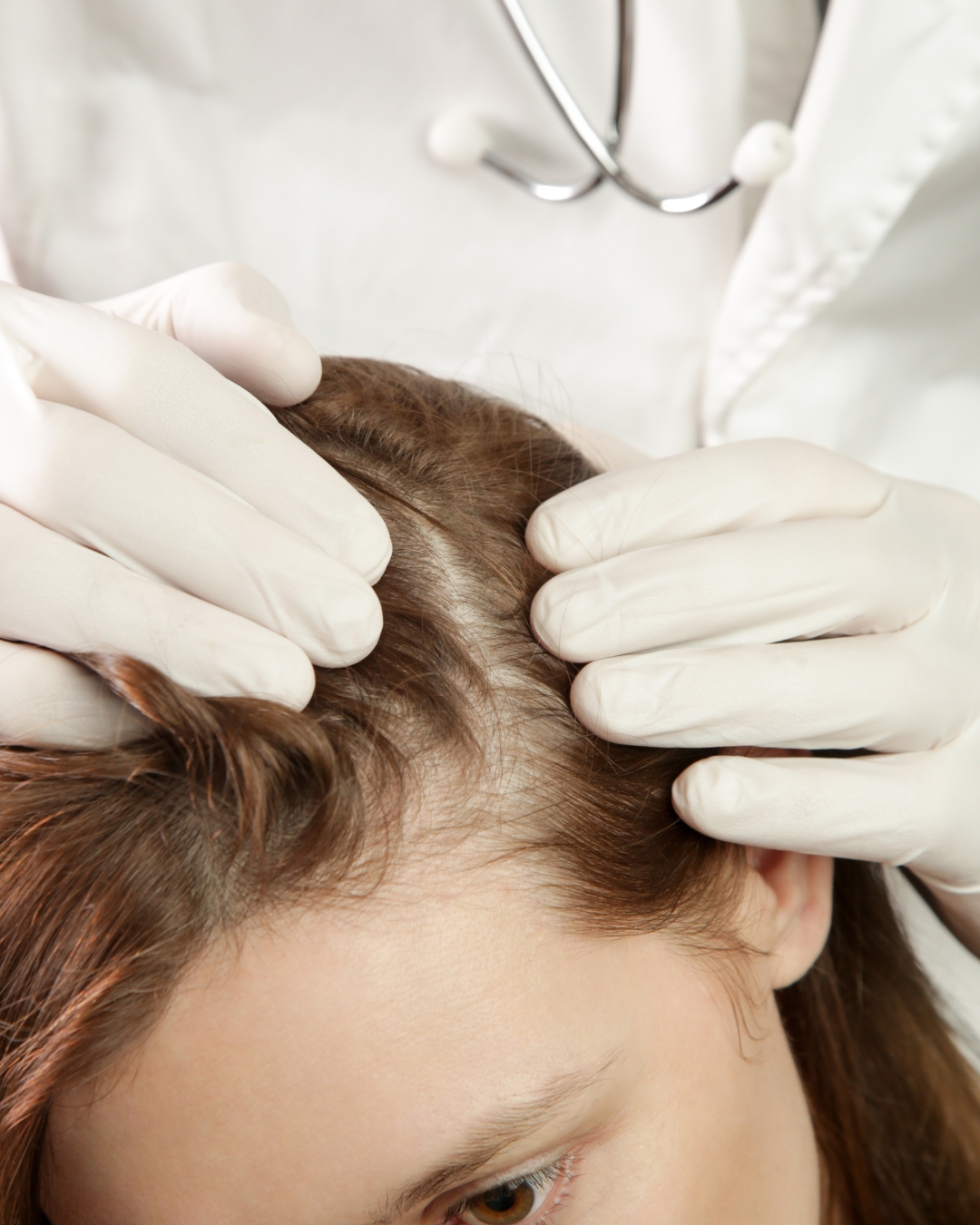 Exosomes for Hair in Hastings