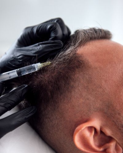 Hair Restoration in Hastings