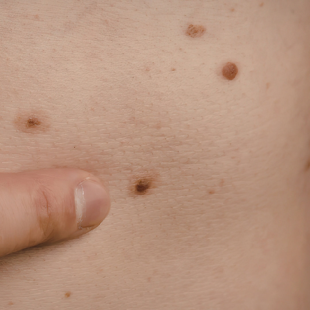 Skin Lesions Hastings