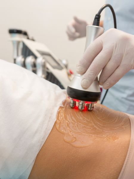 RF Treatment